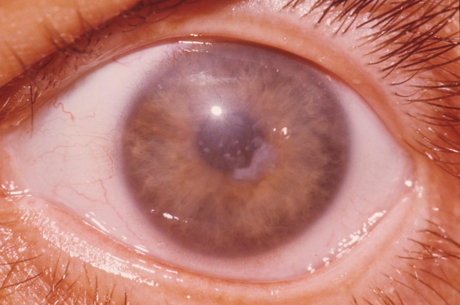 corneal-dystrophy-macular-hereditary-ocular-diseases